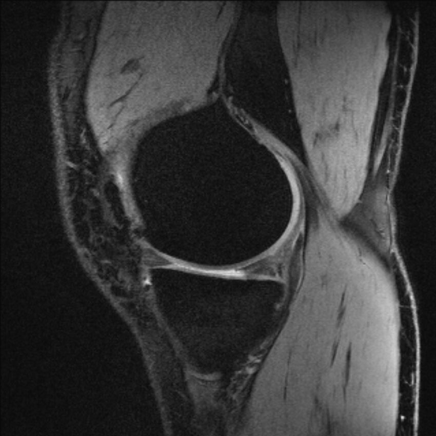 Anterior cruciate ligament mucoid degeneration (Radiopaedia 68400-77933 Sagittal 51).jpg