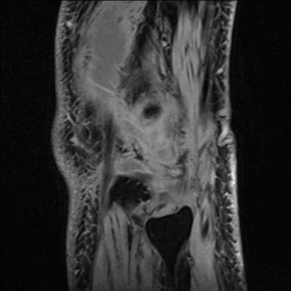 File:Anterior cruciate ligament tear - ramp lesion (Radiopaedia 71883-82322 Sagittal T1 vibe 20).jpg