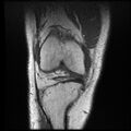 Anterior cruciate ligament tear with posteromedial corner injury, bucket-handle meniscal tear and chondral delamination (Radiopaedia 75501-86744 Coronal T1 8).jpg