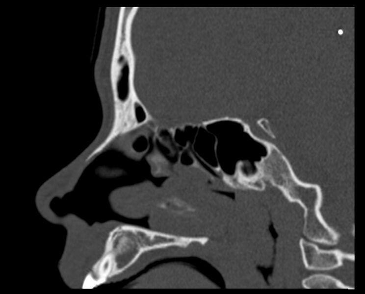 File:Antrochoanal polyp (Radiopaedia 21894-21868 Sagittal bone window 17).jpg
