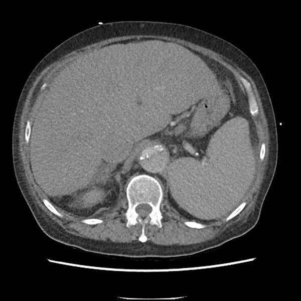 File:Aortic arch graft infection (FDG PET-CT) (Radiopaedia 71975-82437 A 62).jpg