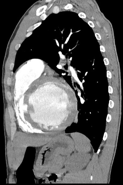 File:Aortic coarctation with aneurysm (Radiopaedia 74818-85828 B 108).jpg