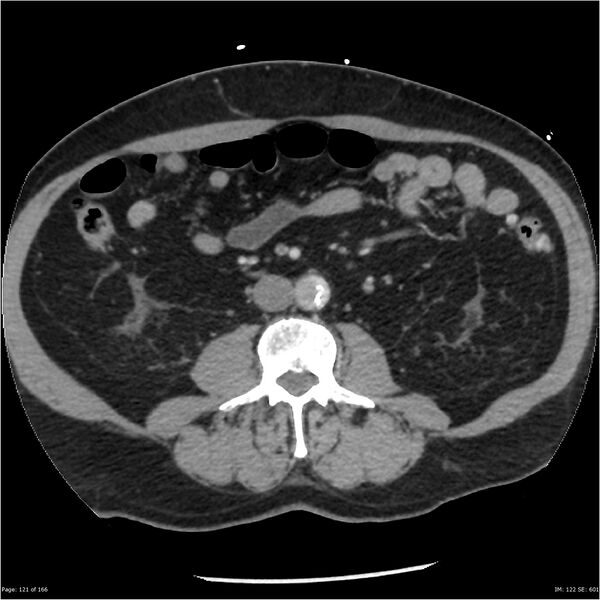 File:Aortic dissection- Stanford A (Radiopaedia 37759-39664 A 112).jpg