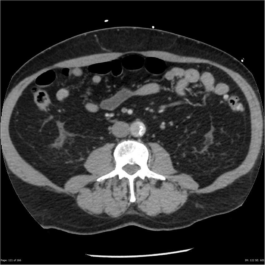 Aortic dissection- Stanford A (Radiopaedia 37759-39664 A 112).jpg
