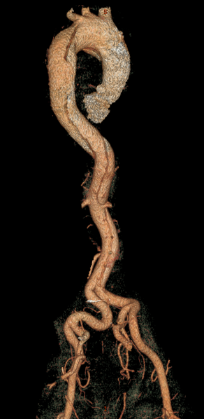 File:Aortic dissection (Radiopaedia 28802-29105 3D 1).png