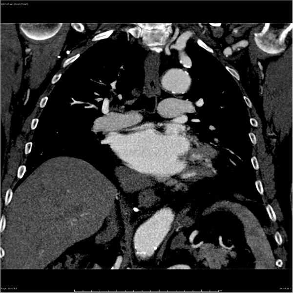 File:Aortic dissection - Stanford type A (Radiopaedia 26183-26315 A 36).jpg