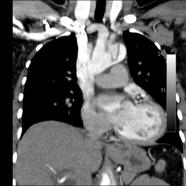 File:Aortic dissection - Stanford type A (Radiopaedia 29247-29659 B 28).jpg