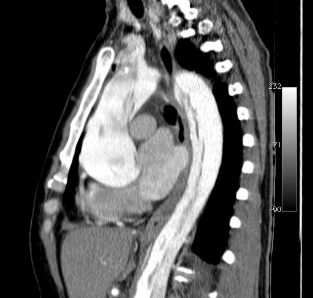 File:Aortic dissection - Stanford type A (Radiopaedia 29247-29659 C 26).jpg