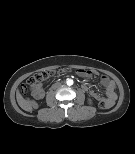 File:Aortic dissection with renal ischemia (Radiopaedia 76573-88338 A 79).jpg
