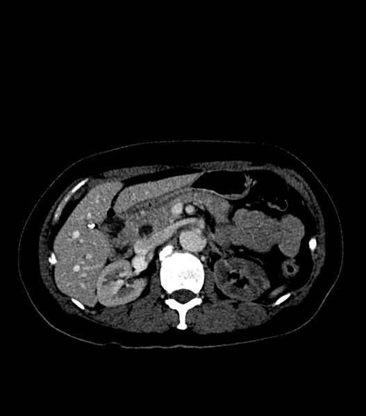File:Aortic dissection with renal ischemia (Radiopaedia 76573-88338 B 32).jpg