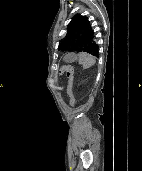 File:Aortoenteric fistula (Radiopaedia 84308-99603 C 298).jpg