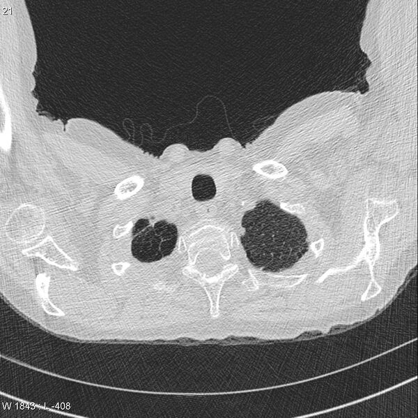 File:Apical non-small-cell lung cancer (Radiopaedia 8570-9405 Axial lung window 2).jpg