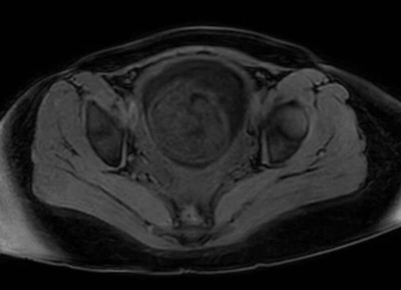 File:Appendicitis in gravida (MRI) (Radiopaedia 89433-106395 Axial DIXON 130).jpg