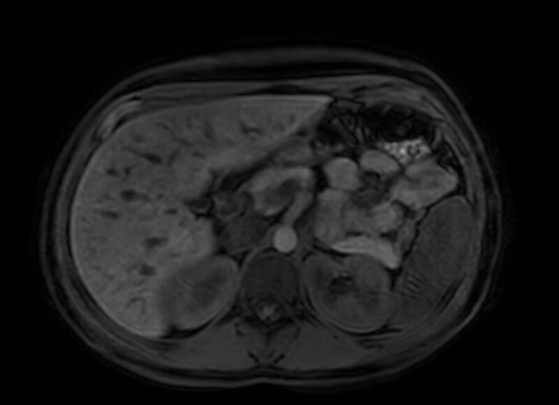 File:Appendicitis in gravida (MRI) (Radiopaedia 89433-106395 Axial DIXON 35).jpg