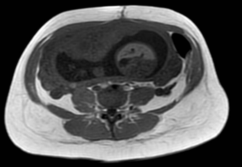File:Appendicitis in gravida (MRI) (Radiopaedia 89433-106395 Axial T1 in-phase 42).jpg