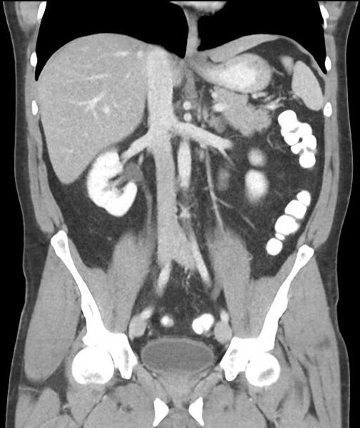 File:Appendicitis with cecal bar sign (Radiopaedia 31878-32830 A 34).jpg