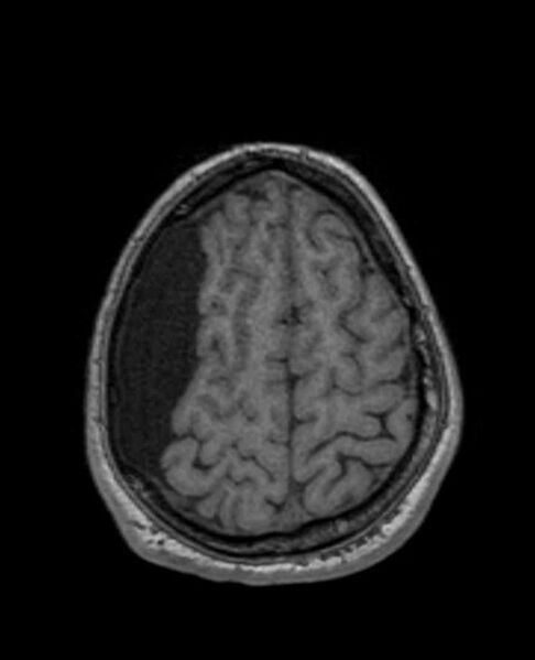 File:Arachnoid cyst- extremely large (Radiopaedia 68741-78451 Axial T1 65).jpg