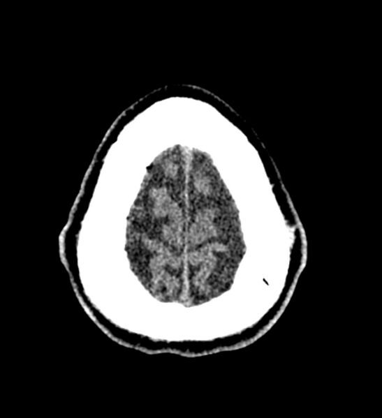 File:Arachnoid cyst of the ambient cistern (Radiopaedia 81301-94986 Axial non-contrast 66).jpg