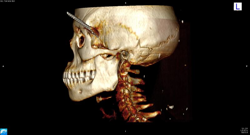 File:Arrow injury to the head (Radiopaedia 75266-86388 3D horizontal 21).jpg
