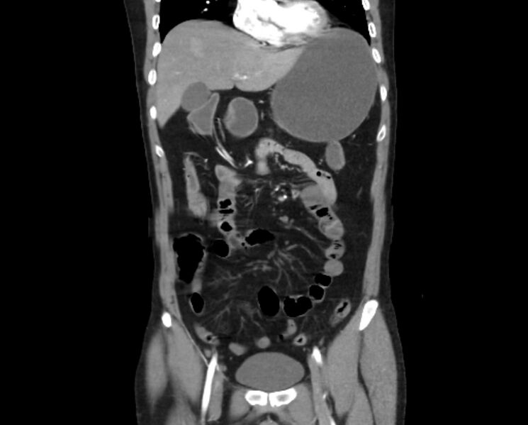 File:Arterial occlusive mesenteric ischemia (Radiopaedia 84641-100060 B 20).jpg