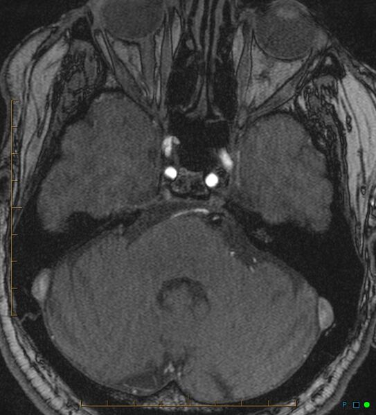 File:Artifactual basilar artery stenosis due to metallic stent (Radiopaedia 31206-31922 Axial MRA 7).jpg