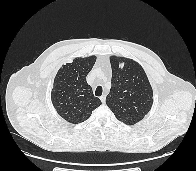 File:Asbestos pleural placques (Radiopaedia 57905-64872 Axial lung window 59).jpg