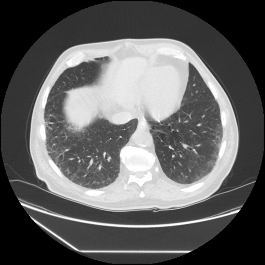 Asbestosis complicated by lung cancer (Radiopaedia 45834-50116 Axial lung window 53).jpg