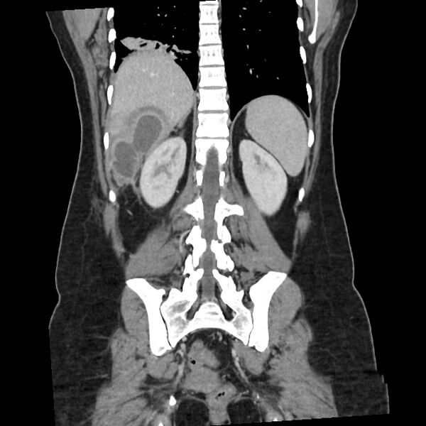 File:Ascending retrocecal appendicitis with liver abscesses (Radiopaedia 60066-67615 C 6).jpg