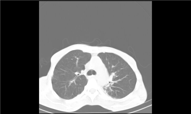File:Aspergilloma (Radiopaedia 20788-20701 Axial lung window 12).jpg