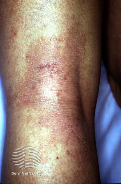 File:Atopic dermatitis (DermNet NZ dermatitis-flexural-eczema05).jpg