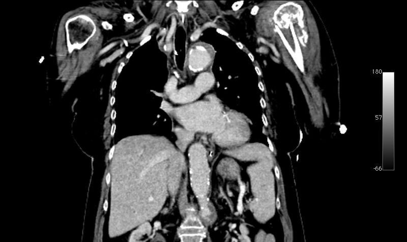 File:Atypical dissection of the thoracic aorta (Radiopaedia 10975-78320 B 18).jpg