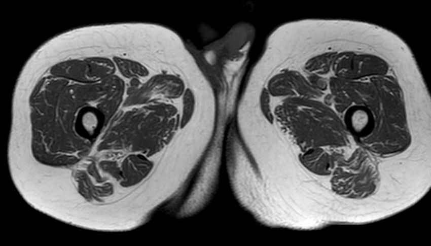 Atypical lipomatous tumor - thigh (Radiopaedia 68975-78734 Axial T1 68).jpg