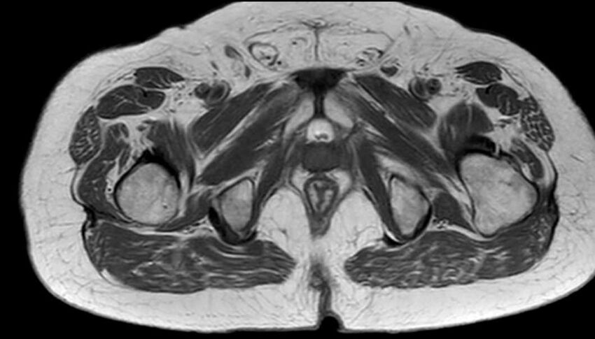 Atypical lipomatous tumor - thigh (Radiopaedia 68975-78734 Axial T1 86).jpg