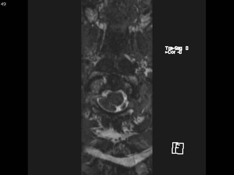 File:Atypical meningioma - intraosseous (Radiopaedia 64915-74572 Axial CISS 49).jpg