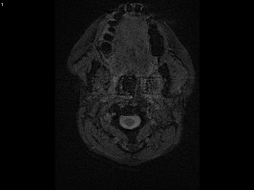 Atypical meningioma - intraosseous (Radiopaedia 64915-74572 Axial SWI 1).jpg