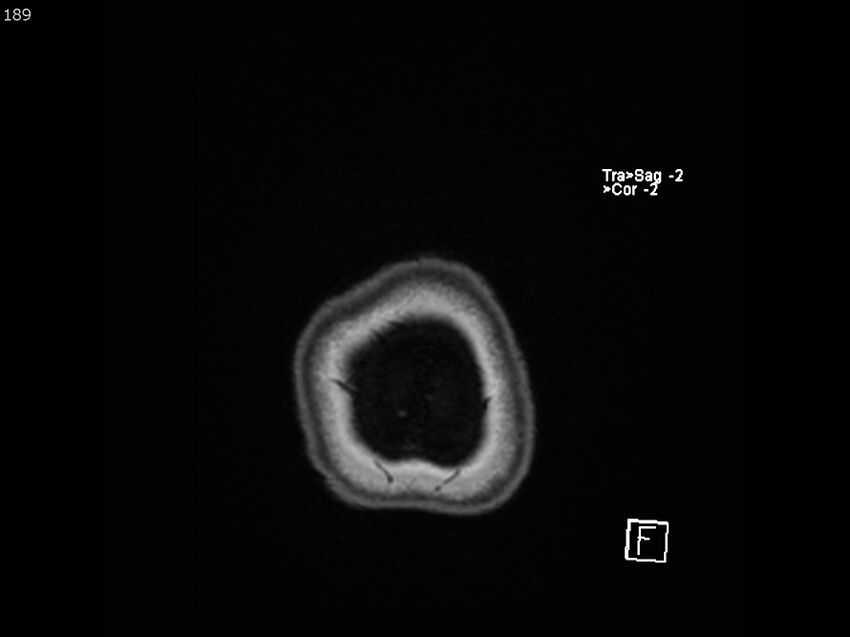 Atypical meningioma - intraosseous (Radiopaedia 64915-74572 Axial T1 189).jpg