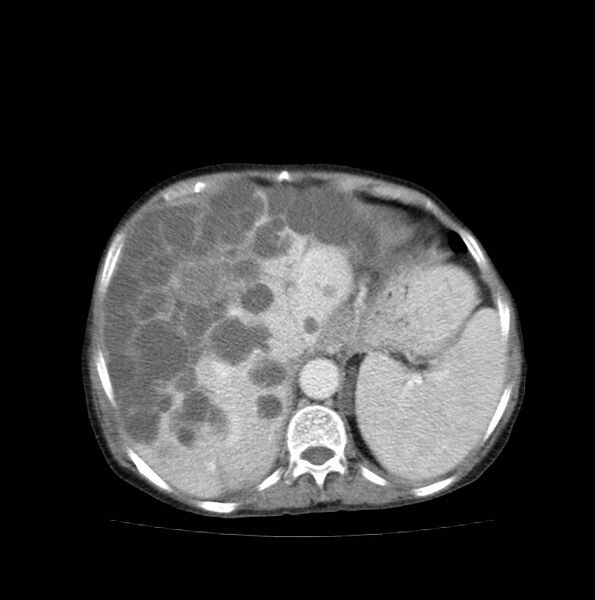 File:Autosomal dominant polycystic kidney disease (Radiopaedia 16777-16490 A 12).jpg