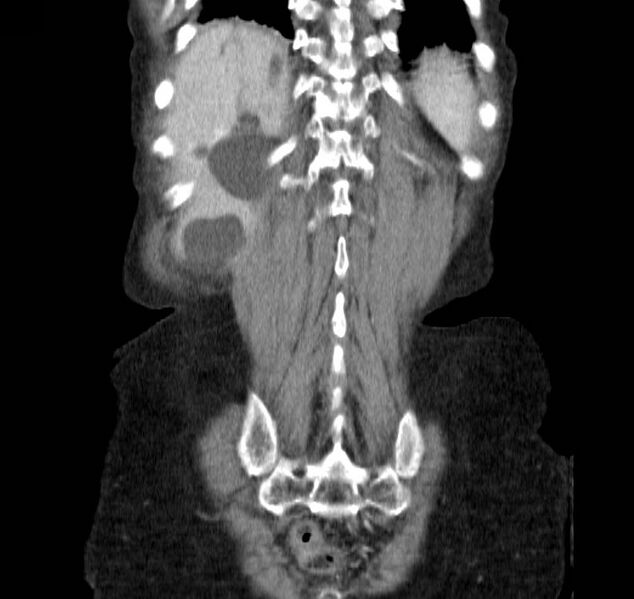 File:Autosomal dominant polycystic kidney disease (Radiopaedia 16777-16490 B 41).jpg