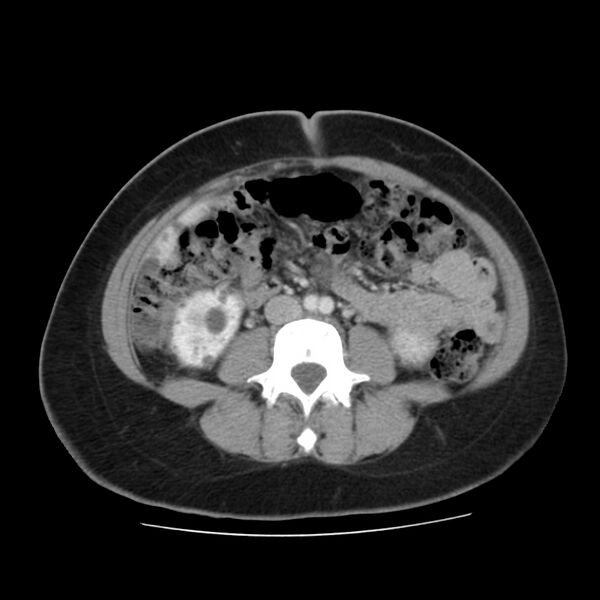 File:Autosomal dominant polycystic kidney disease (Radiopaedia 23061-23093 C 39).jpg