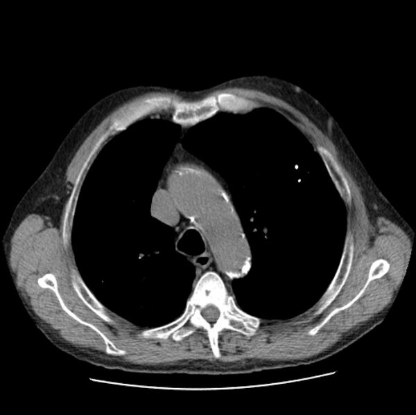 File:Autosomal dominant polycystic kidney disease (Radiopaedia 27851-28094 Axial non-contrast 17).jpg