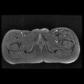 Avascular necrosis of the hip (Radiopaedia 29563-30067 Axial T1 C+ fat sat 17).jpg