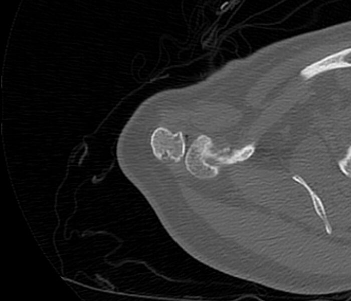 File:Avulsion fracture - greater tuberosity of humerus (Radiopaedia 71216-81514 Axial bone window 10).jpg