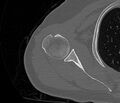Avulsion fracture - greater tuberosity of humerus (Radiopaedia 71216-81514 Axial bone window 40).jpg