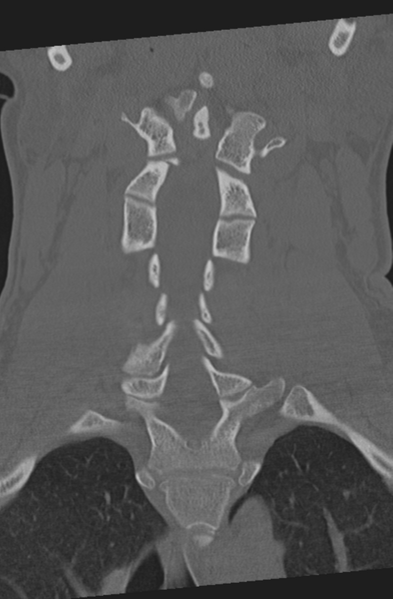 File:Axis peg fracture (type 3) and atlas lateral mass (type 4) fracture (Radiopaedia 37474-39324 Coronal bone window 24).png