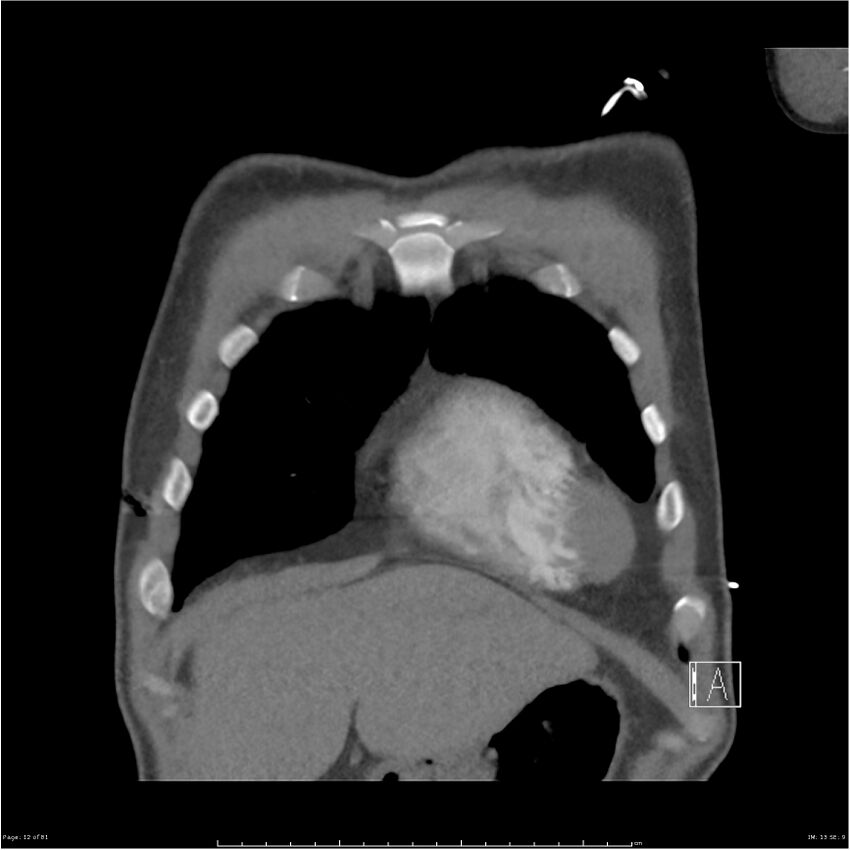 Azygos venous system anatomy (CT pulmonary angiography) (Radiopaedia 25928-26077 Coronal C+ CTPA 12).jpg