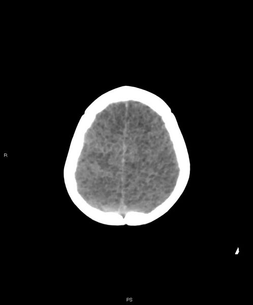 File:Basal ganglia and parenchymal ischemia (Radiopaedia 45818-50083 Axial non-contrast 6).jpg