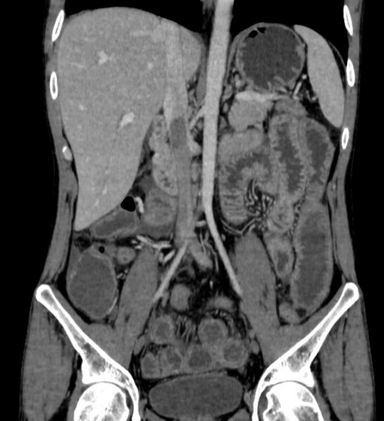 File:Behçet's disease- abdominal vasculitis (Radiopaedia 55955-62570 B 29).jpg