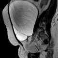 Benign seromucinous cystadenoma of the ovary (Radiopaedia 71065-81300 Sagittal T2 16).jpg