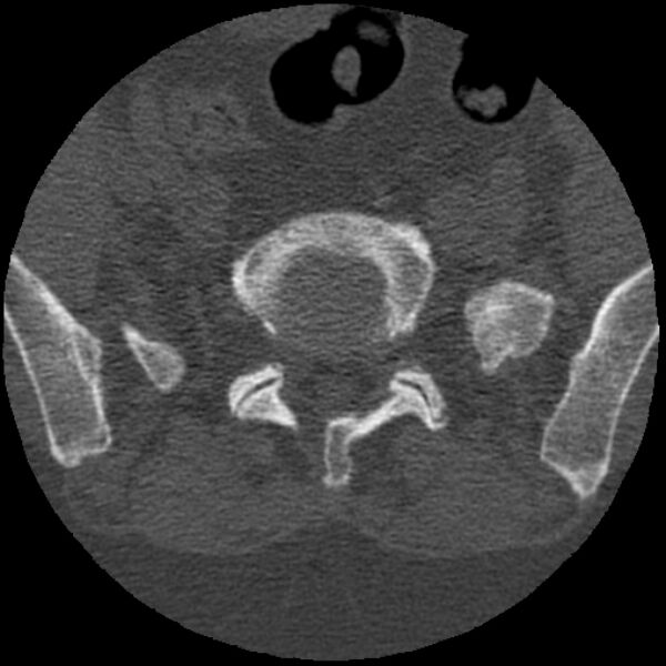 File:Bertolotti syndrome (Radiopaedia 24864-25128 Axial bone window 26).jpg