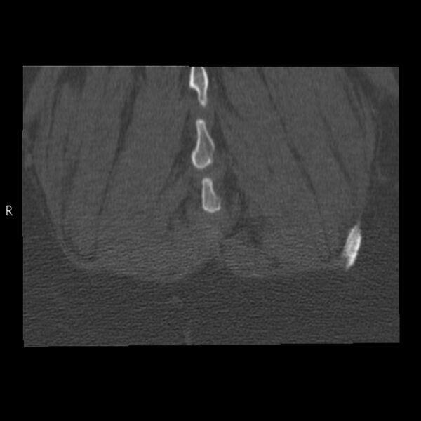 File:Bertolotti syndrome (Radiopaedia 24864-25128 Coronal bone window 50).jpg